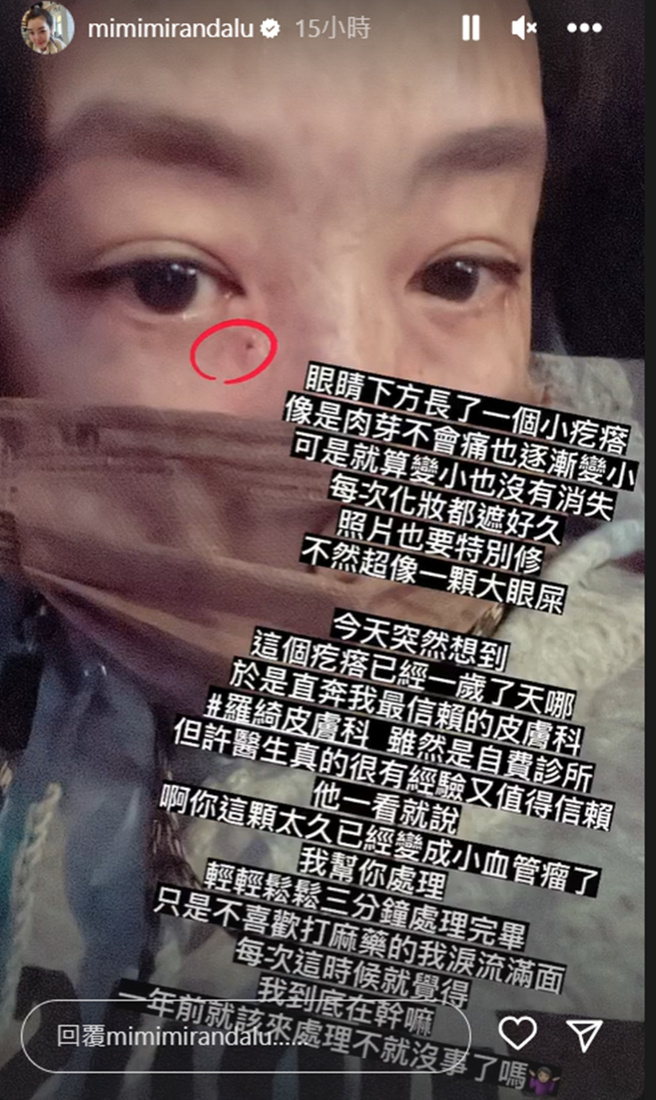 路嘉怡眼睛下方长了小肉芽，没想到未多加理会竟变成小血管瘤。(mimimirandalu IG)