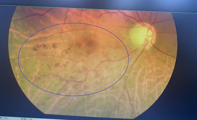 60多岁黄太太右眼患有飞蚊症多年并未在意，日前诊断出右眼眼中风併发黄斑部水肿，更检查出有青光眼和视网膜剥离，经药物治疗及雷射手术治疗才免于失明危机。（长安医院提供／潘虹恩台中传真）
