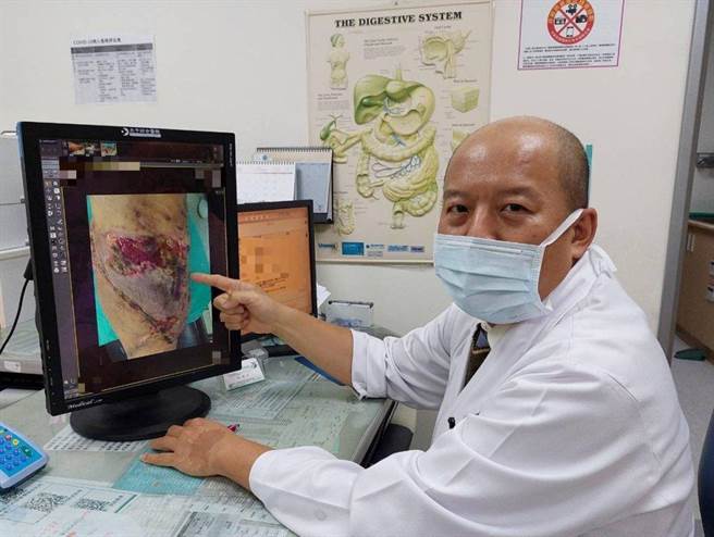 大千医院医师林泽村表示，洪先生伤口太深无法负载皮肤移植，因此让他接受高压氧治疗，帮助癒合伤口。（大千医院提供／谢明俊苗栗传真）