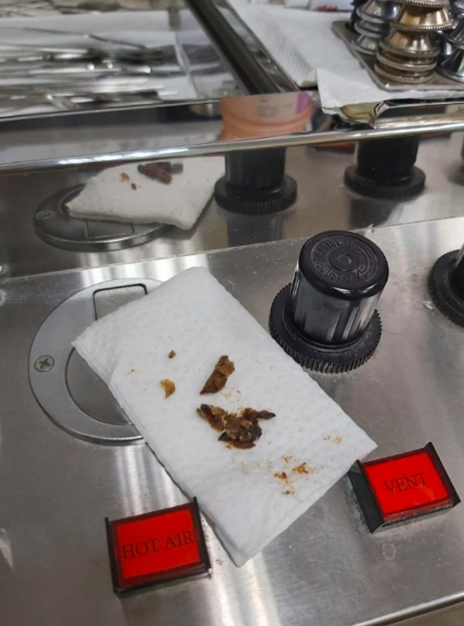 女网友和大家分享巨大耳屎的照片，意外在网路上掀起热烈讨论。（图／Dcard网友授权使用）
