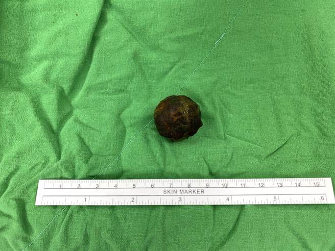 高医从老妇肠道内取出２公分的胆结石。（高雄医学大学附设中和纪念医院提供／杨舒婷高雄传真）