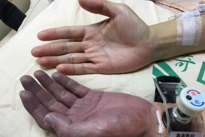 接受心导管手术的患者在术后容易因肢体疼痛、发绀等不适感，引发情绪焦虑，奇美医学中心加护病房导入音乐辅助照护，实行至今评估收到不错成效。（图/ 中央社）