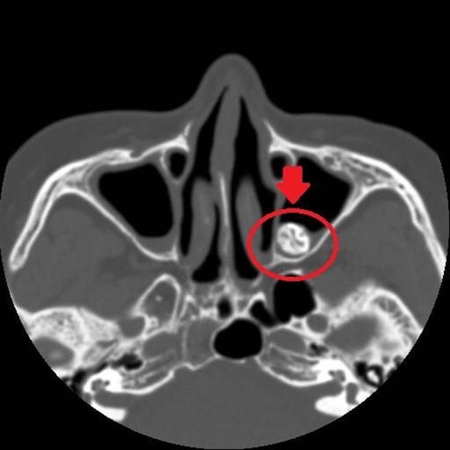 亞洲大學附屬醫院耳鼻喉部部長田輝勣指出，「異生齒」常見案例多出現在上顎骨部位，該婦人發生位置卻在鼻腔內，臨床出現機率極低。（亞大附醫提供／潘虹恩台中傳真）