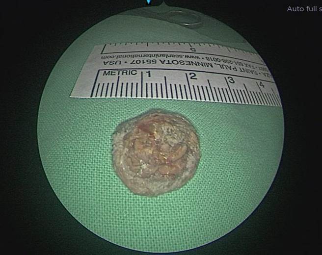 醫師術中透過磁導航3D立體定位系統，快速找到異生齒位置並取出，前後僅耗時30分鐘，取出之異生齒約2公分大。（亞大附醫提供／潘虹恩台中傳真）