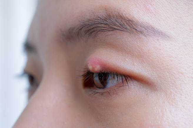 醫師表示，針眼是所有人都可能發生的眼皮腺體炎症。( 示意圖/ Shutterstock )