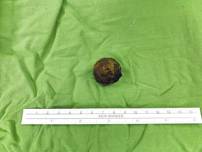 高雄74岁妇人因上腹痛、噁心与呕吐被送往高雄医学大学附设中和纪念医院急诊，经检查疑似为罕见的胆结石跑进肠胃道，经手术后取出2公分大小的胆结石。（高雄医学大学附设中和纪念医院提供／杨舒婷高雄传真）