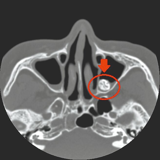 亚洲大学附属医院耳鼻喉部部长田辉勣指出，「异生齿」常见案例多出现在上颚骨部位，该妇人发生位置却在鼻腔内，临床出现机率极低。（亚大附医提供／潘虹恩台中传真）