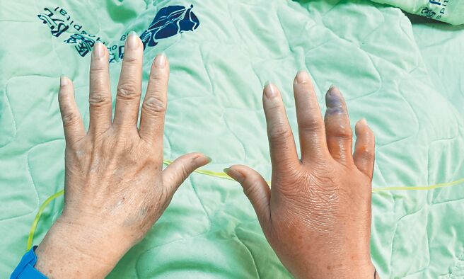 一名妇人处理鲷鱼时，手指遭鱼鳍刺伤，就医诊断为海洋弧菌引发的坏死性筋膜炎。（南投医院提供／杨静茹南投传真）