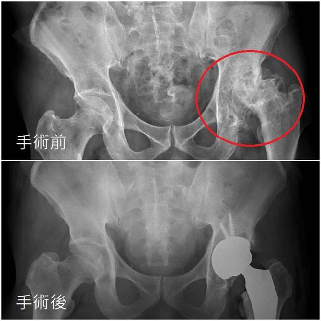 台中56岁林先生因长期喝酒应酬导致左侧「股骨头缺血性坏死」，幸经「全髋关节手术导引系统」置换人工髋关节顺利恢復。（亚大附医提供／潘虹恩台中传真）
