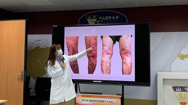 中山附医皮肤科医师萧玉屏说，新一代口服标靶药物锐虎会针对促进发炎的细胞激素做讯号阻断，控制细胞激素分泌，以达到良好的皮肤病灶及搔痒症状改善。（中山附医提供／潘虹恩台中传真）