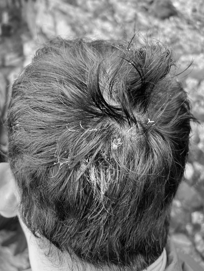 花莲地震后，玉山随即发生落石意外，主峰线有5名山友遭落石砸重受轻伤。（南投县消防局提供／廖志晃南投传真）