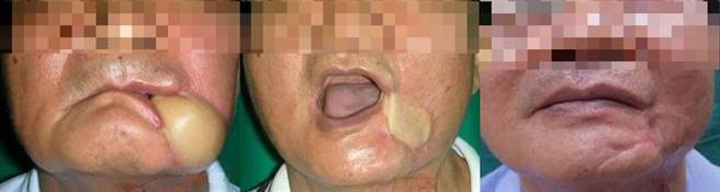 高雄醫學大學附設中和紀念醫院外科部長郭耀仁團隊，讓口腔癌患者的嘴邊肉團不再影響生活。（高雄醫學大學附設中和紀念醫院提供／楊舒婷高雄傳真）