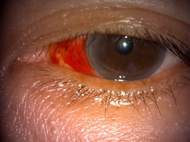 六旬翁被家人发现右眼眼白红了一大半，家人怀疑是眼中风急就医，原因竟是上厕所太用力，才导致眼球微血管破裂。（万芳医院提供／林周义台北传真）