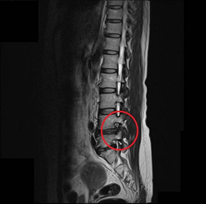 吴女的椎间盘突出压迫神经(红圈处)，造成左脚疼痛症状。（大千医院提供／谢明俊苗栗传真）