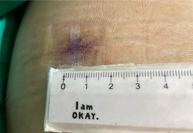 内视镜手术伤口小于1公分，恢復速度快。（大千医院提供／谢明俊苗栗传真）