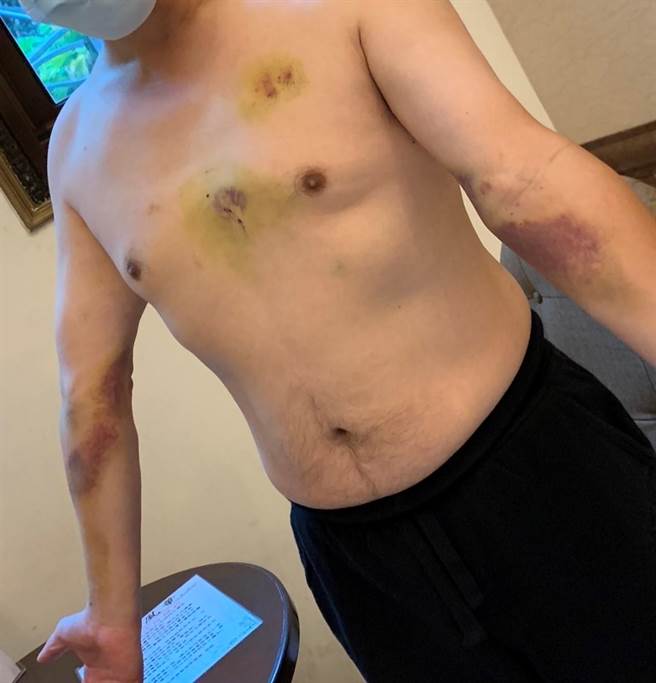 47岁李先生10内3度心肌梗塞，去年寒流来袭已经减肥、戒菸的他，慢跑后回到车上休息猝死，经送医救回，身上留下寒流的烙印。（施胜桓提供／冯惠宜台中传真）