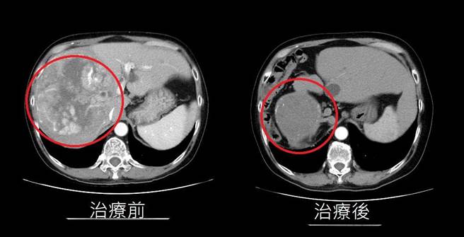 台中黄姓男子4年前因爆瘦、腹痛且易感疲倦就医，意外发现竟有1颗15公分大巨型肝臟肿瘤，经三合一疗法治疗顺利恢復。（亚大附医提供／潘虹恩台中传真）
