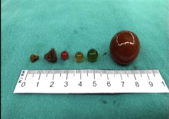 经2次开刀后，医生从男童肠道中取出多颗水晶宝宝。（高雄长庚纪念医院提供／杨舒婷高雄传真）