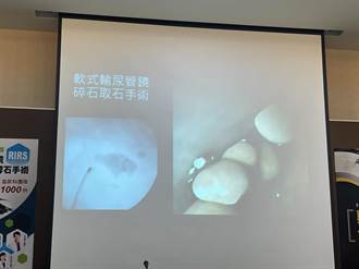 小港醫院軟式輸尿管鏡碎石手術 讓7旬男不留疤「無石一身輕」