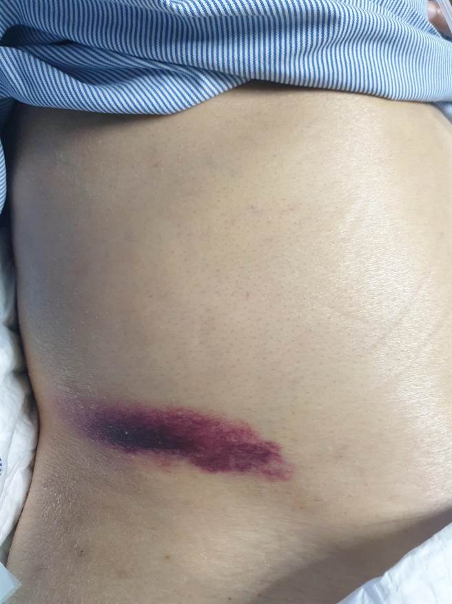 一名52岁男性因C肝带原合併肝硬化导致肝昏迷，屏基胃肠肝胆科主治医师蔡元荣在病人的右侧腹股沟发现约15公分的瘀青。（屏基提供／谢佳潾屏东传真）