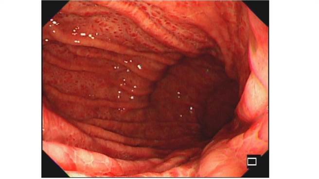 屏基发现全球文献首例成人自发性腹股沟瘀青病例，登上国际期刊。。（屏基提供／谢佳潾屏东传真）