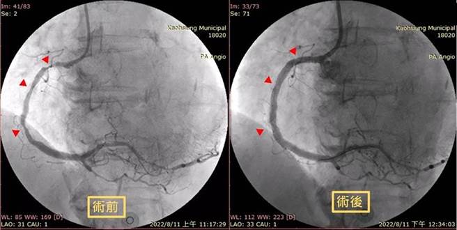 冠状动脉涂药支架放前后对照图。（高雄市立联合医院提供／杨舒婷高雄传真）