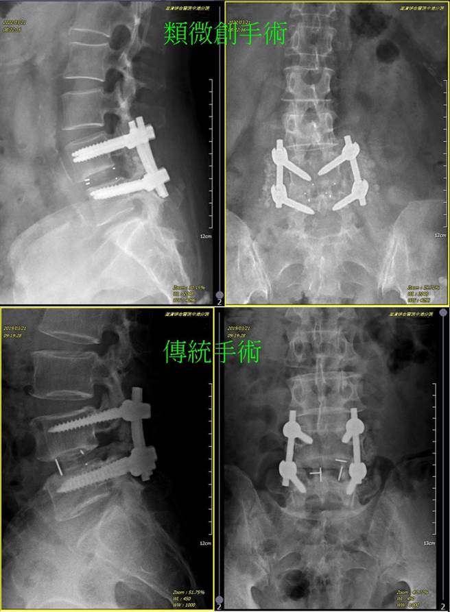 澄清医院骨科医师钟文隆表示，类微创脊椎手术手术传统切口进入后，不会剥离脊椎旁的肌肉，而採用背肌外侧沿肌纤维走向，可以深达腰椎患部需钢钉植入的椎节地方，再进行钢钉植入。（澄清医院提供／冯惠宜台中传真）