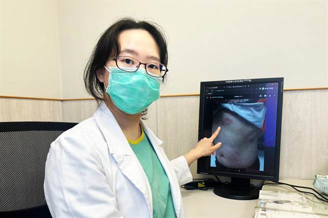 中医大新竹附医感染科主任张凯音指「带状疱疹」有许多年轻案例，近1年新冠肺炎确诊病人病癒后，遇带状疱疹发作也相当常见。（罗浚滨摄）