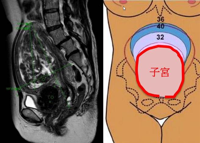 黄小姐的子宫肌瘤直径达15公分，重量超过1公斤。（高雄长庚医院提供／袁庭尧高雄传真）