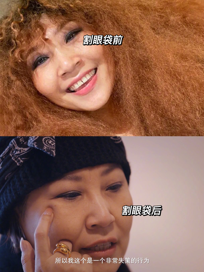 张蔷自揭割眼袋。（图／翻摄自影视圈达人微博）