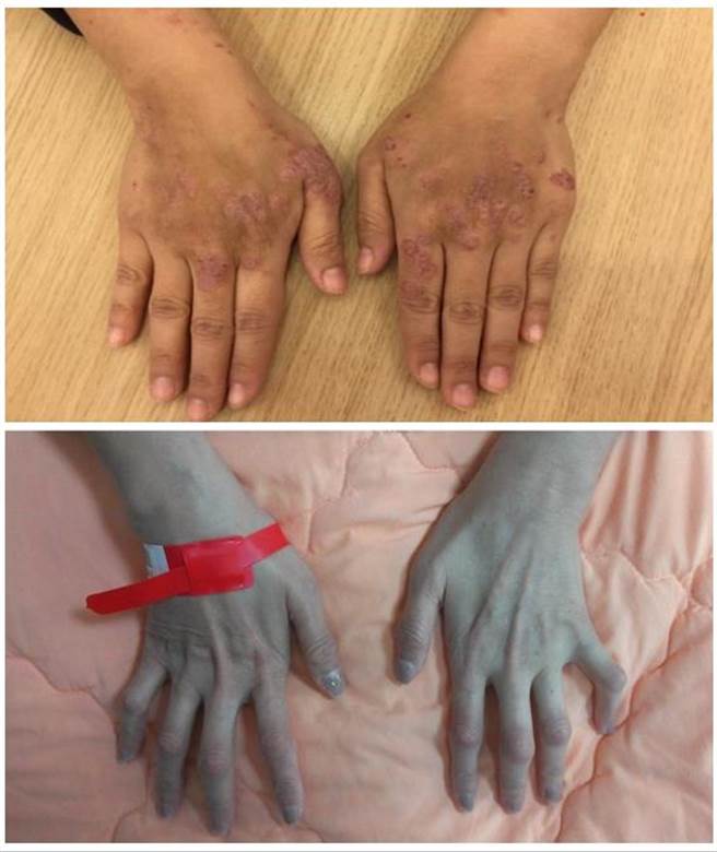 紫質症患者曝曬在陽光下引起皮膚疹子（上圖），若未接受適當治療甚至會引起嚴重周邊神經病變（下圖）。（台中榮總提供／潘虹恩台中傳真）