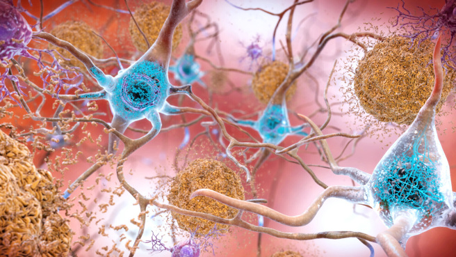 美国食品暨药物管理局（FDA）6日批准阿兹海默症治疗新药「Lecanemab」，实验中这项疗法延缓患者认知下降27%。图为美国国家老化研究所（National Institute on Aging）绘制的阿兹海默症患者大脑示意图。（示意图／美联社、美国国家老化研究所提供）