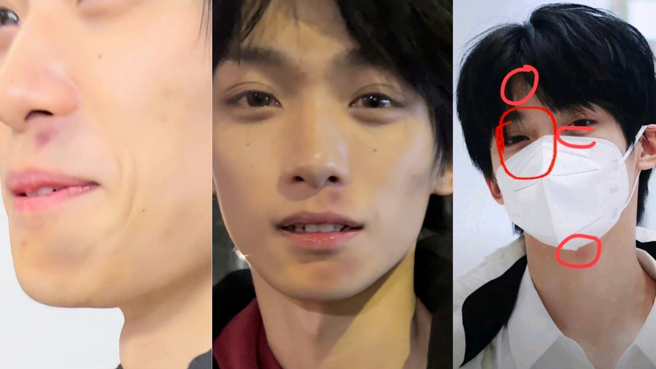 梓渝多次被粉丝拍到脸部明显瘀青。（图／截图自微博）