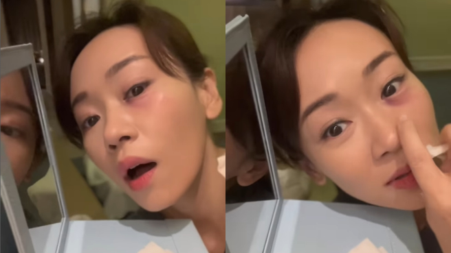 杨思琦的左眼险些失明。(图/杨思琦 IG)