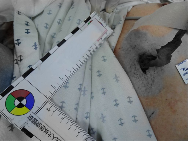 手术从前胸原本伤口处，从纵膈腔里小心翼翼将刀片成功取出。（大林慈济医院提供∕吕妍庭嘉义传真）