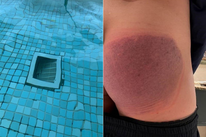 张姓男子在「全球饭店住起来」脸书社团分享，日前在花莲远雄悦来饭店体验室内水疗池，疑因池子底部排水孔破裂，将欲起身的他直接往下水道方向拉去，让他头部多次几乎灭顶，经用尽力气往旁边拉扯，才顺利脱离险境。（张姓网友提供／罗亦晽花莲传真）