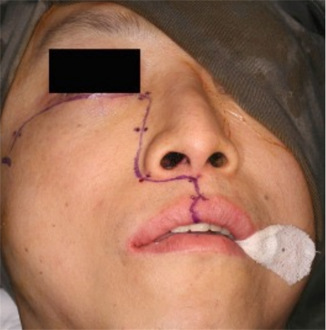 18岁陈姓少女因出车祸送长庚医疗财团法人高雄长庚纪念医院急诊，长庚医院鼻科副教授罗盛典摆脱传统手术方式，将陈女的眼球在没有伤疤下的情况復位。（医师罗圣典提供／杨舒婷高雄传真）