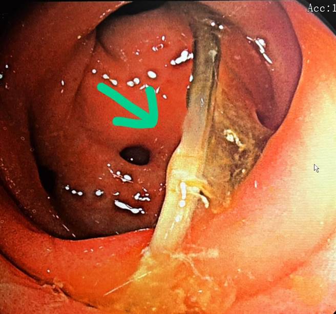 透过大肠镜检查才发现是长4公分的鱼刺卡在乙状结肠，尖刺两端还牢牢地刺在大肠壁上。（圣马尔定医院提供∕吕妍庭嘉义传真）