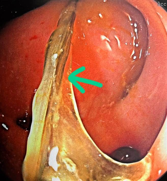 透过大肠镜检查才发现是长4公分的鱼刺卡在乙状结肠，尖刺两端还牢牢地刺在大肠壁上。（圣马尔定医院提供∕吕妍庭嘉义传真）