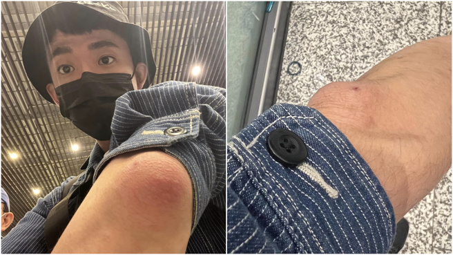 阿滴晒出患部照片。(图／翻摄自阿滴英文脸书)