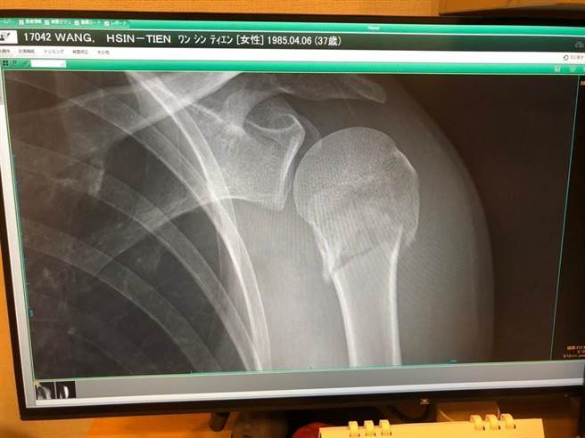 王心恬看到Ｘ光片左手断掉，脑筋一片空白。（凯渥提供）