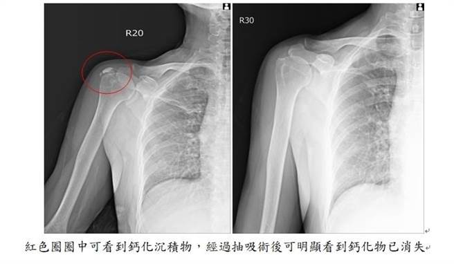 X光显示，洪小姐右肩峰下有一钙化结晶病灶。（高雄市民生医院提供／袁庭尧高雄传真）