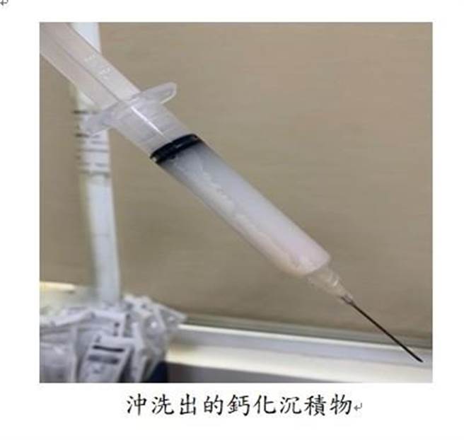 医师在洪小姐右肩抽出满满一个大针筒的钙化物质。（高雄市民生医院提供／袁庭尧高雄传真）