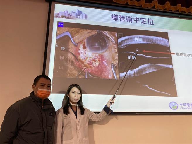 张先生透过「青光眼导管植入术」，并辅以「眼内OCT术中断层定位」，精准定位后植入极微细的引流导管，降低眼压，减缓视神经受损。（冯惠宜摄）