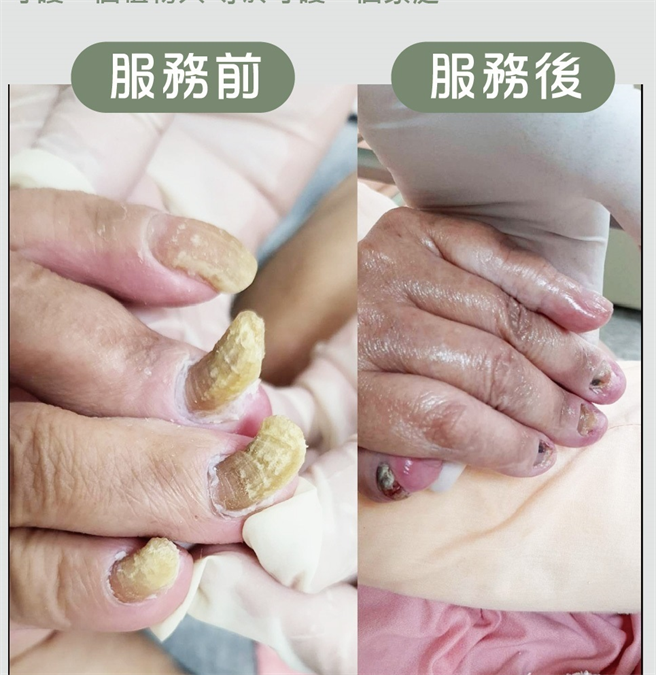 卧床十余年惊见女巫手指，创世生服员耗时2小时帮变身。(创世提供)