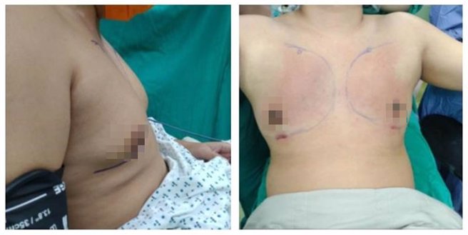 25岁男子手术前胸部宛如B罩杯（左），手术前后恢復男性正常胸部（右）。（澄清医院提供／冯惠宜台中传真）