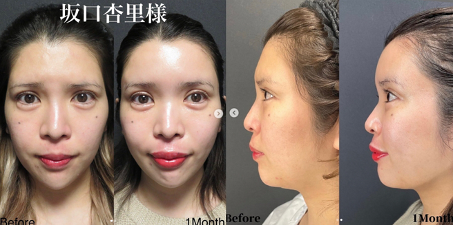 坂口杏里不久前跑去整形，让网友看傻眼，忍不住骂她「妳妈妈会伤心难过」。（图／摘自坂口杏里IG）