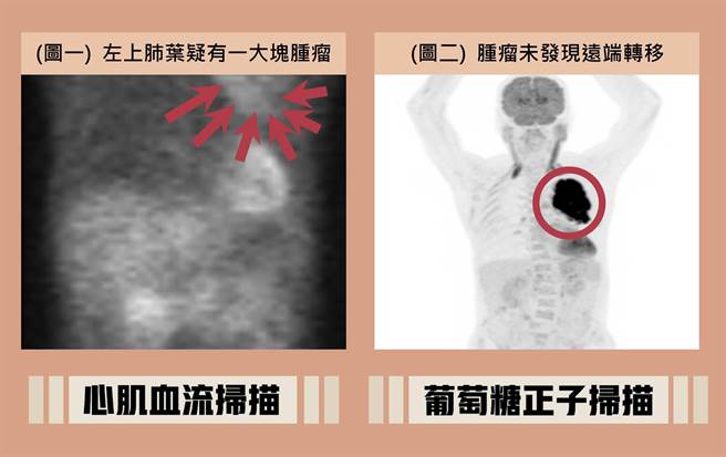 王爷爷因胸闷就医，竟意外发现肺部肿瘤。（大千医院提供／李京升苗栗传真）