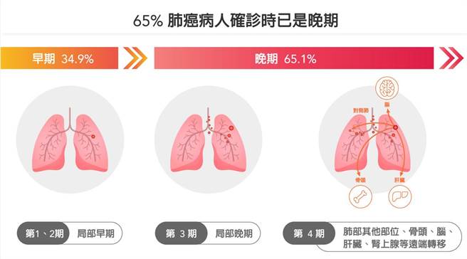 医师陈沛兴表示，有65％的肺癌病人确诊时已是晚期，建议民眾预防胜于治疗，针对有家族病史或是有吸菸习惯的高风险族群，应及早筛检、接受治疗。（新竹台大分院提供／王惠慧新竹传真）