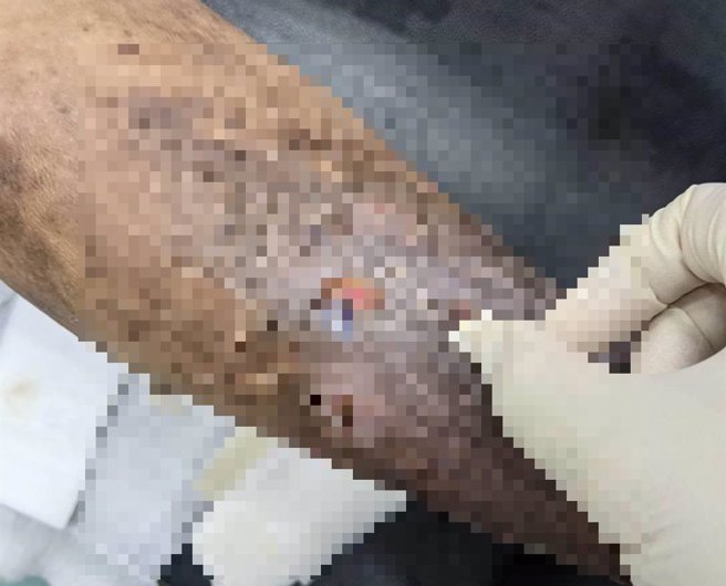 亚洲大学附属医院心臟外科主治医师李修安指出，郁积血液则会渗出血管在皮下堆积，血中的铁逐渐沉积，造成脚掌小腿皮肤变黑。（亚大附医提供／潘虹恩台中传真）